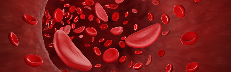 illustration of sickle cells in bloodstream